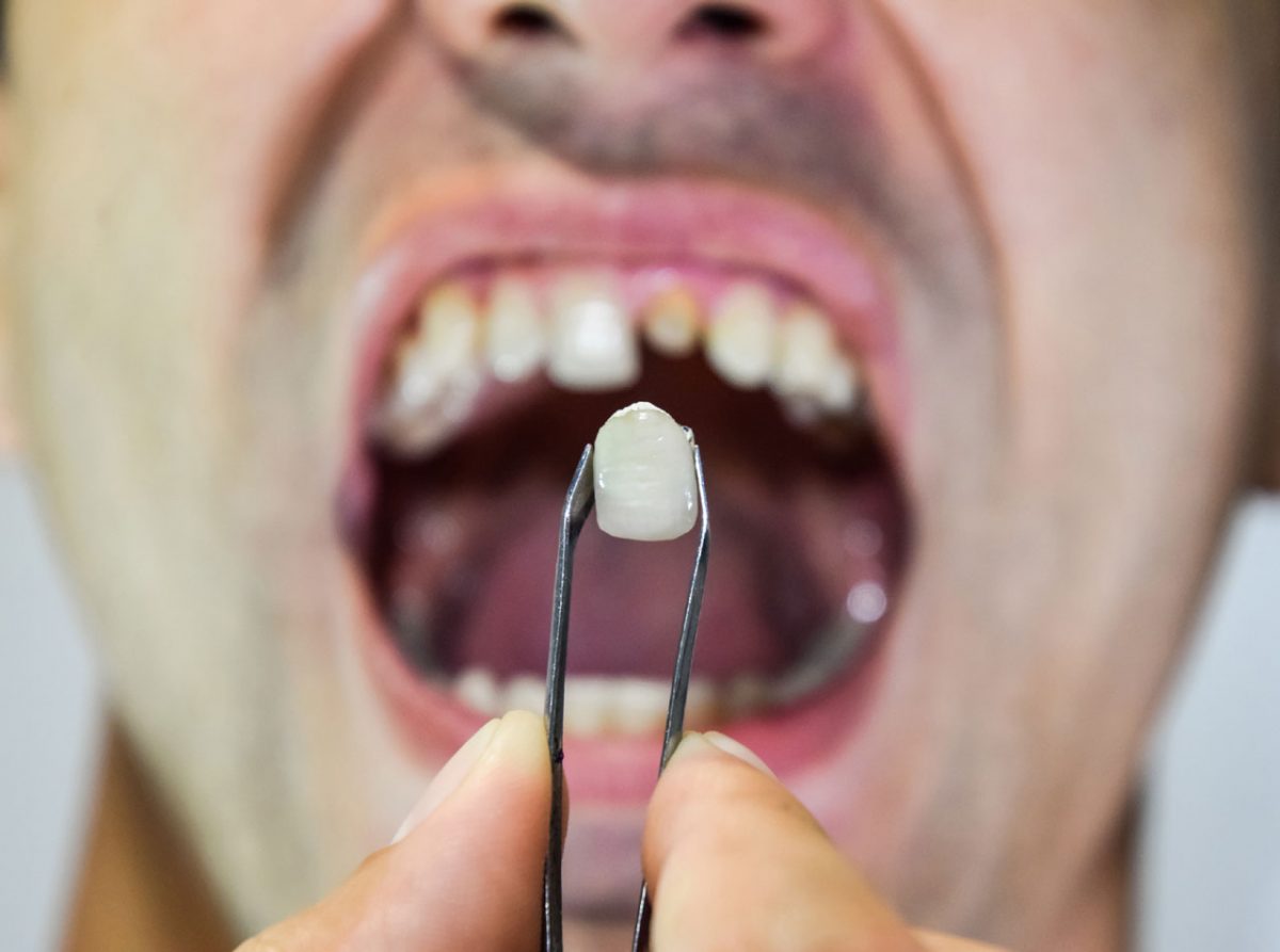 کاشت پایه ایمپلنت دندان