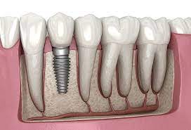 جراحی ایمپلنت دندان