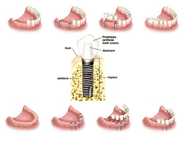 انواع کاشت دندان