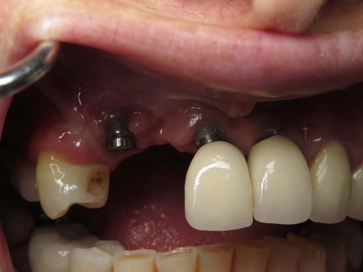 کاربرد ایمپلنت دندان