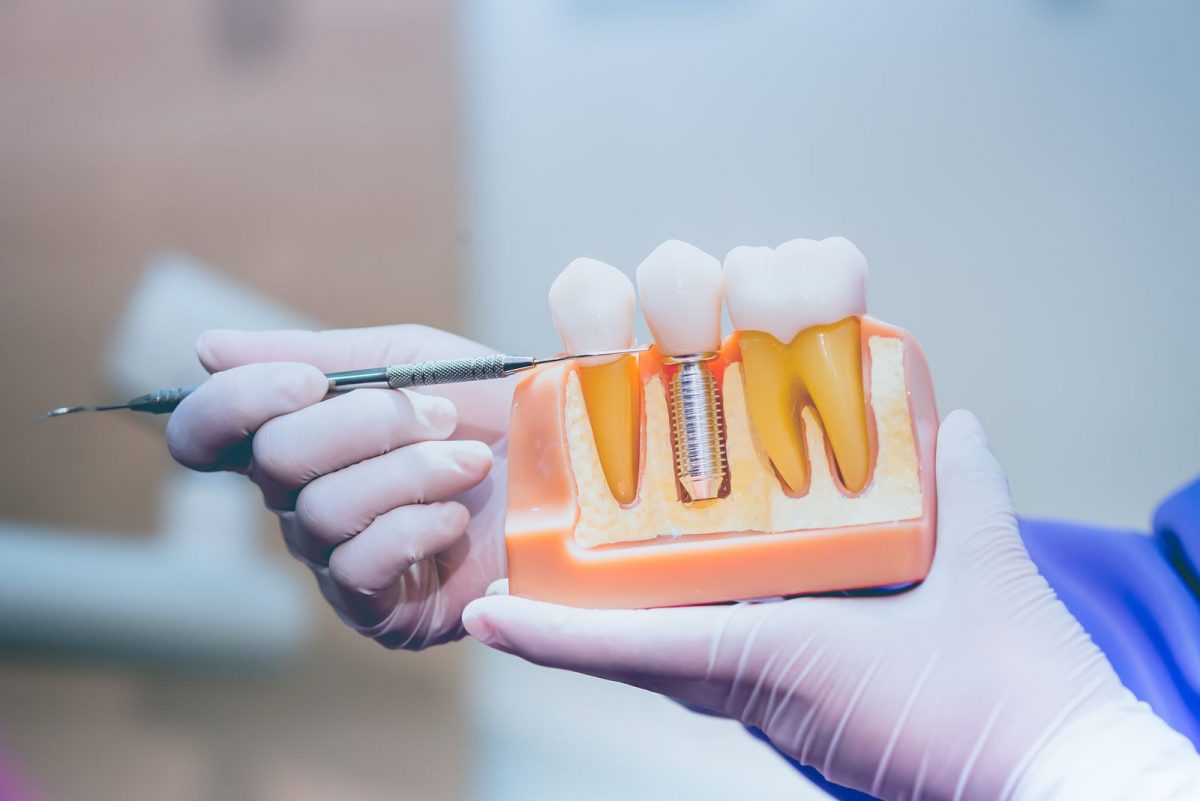 موفقیت ایمپلنت دندان