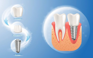 روش کاشت ایمپلنت دندان