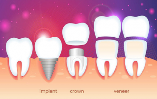ایمپلنت های دندان