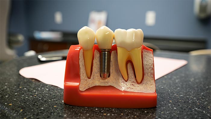 بهترین جایگزین دندان