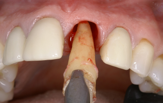 کاشت ایمپلنت فوری دندان