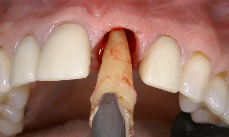 کاشت ایمپلنت فوری دندان