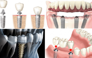 معایب ایمپلنت دندان