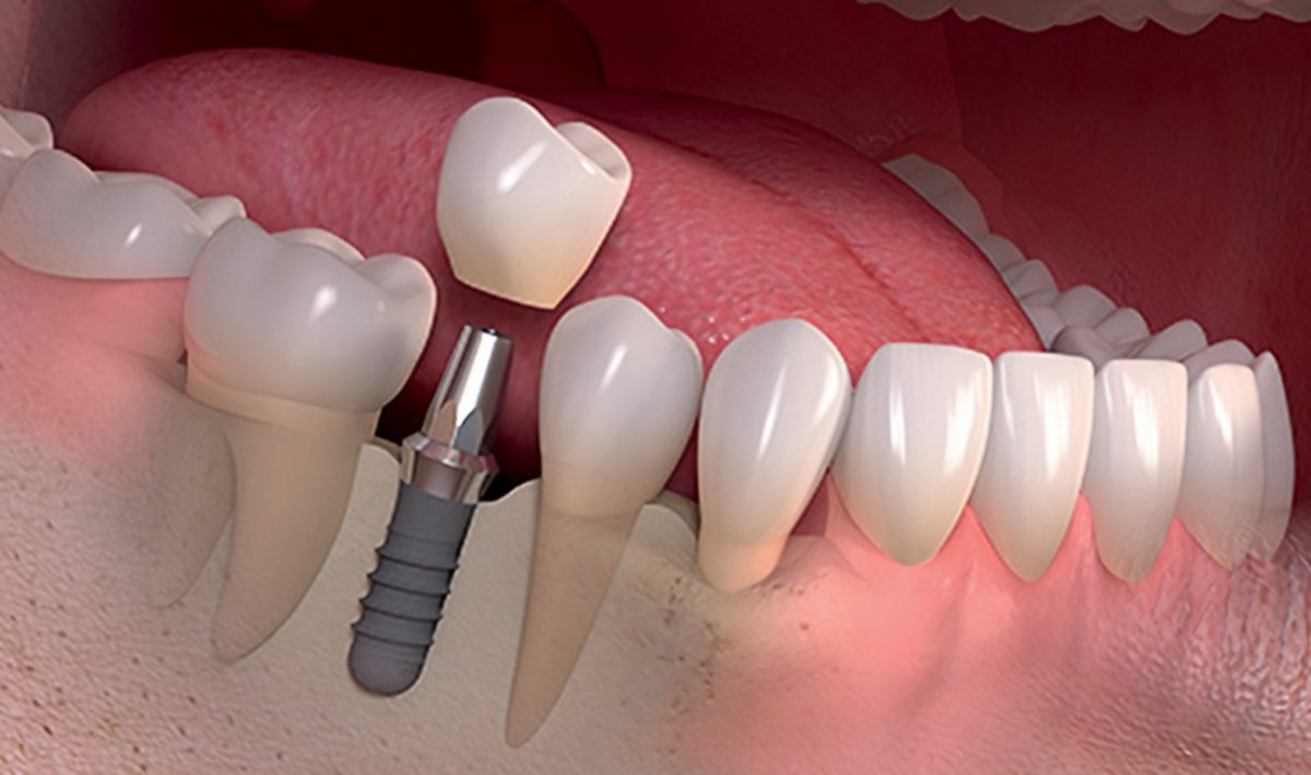 مزایای کاشت دندان