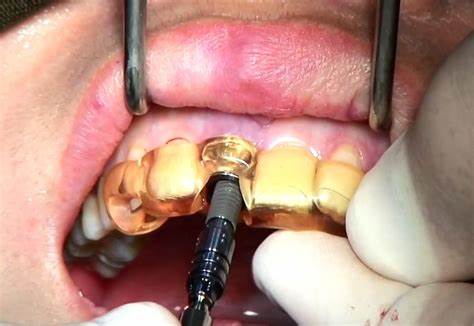 اهمیت کاشت ایمپلنت دندان