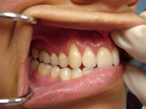 بررسی دندان ها قبل از کاشت ایمپلنت