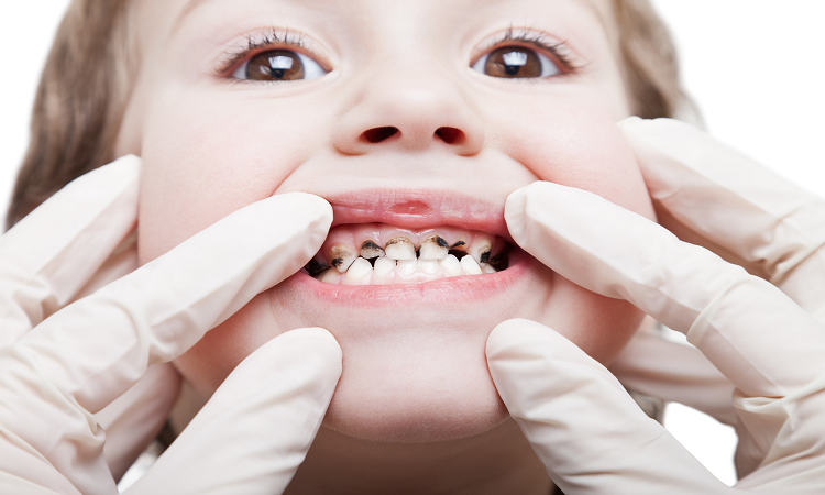 آسیب های احتمالی دندان کودکان
