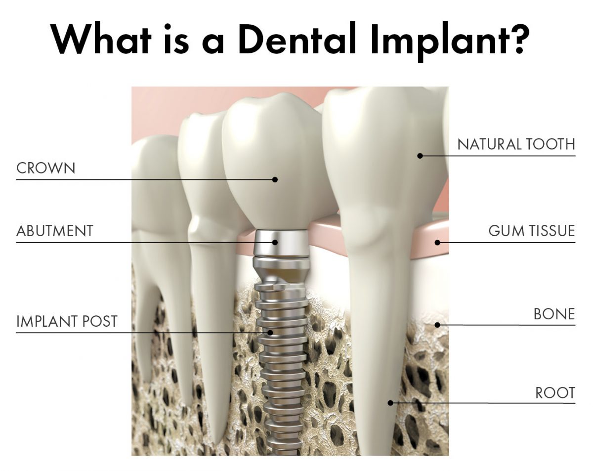 ایمپلنت دندان چیست؟