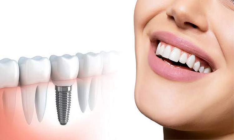 تفاوت های اساسی ایمپلنت و دندان مصنوعی