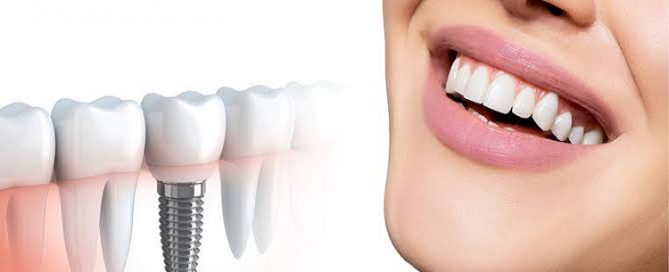 انواع مدل ایمپلنت دندان