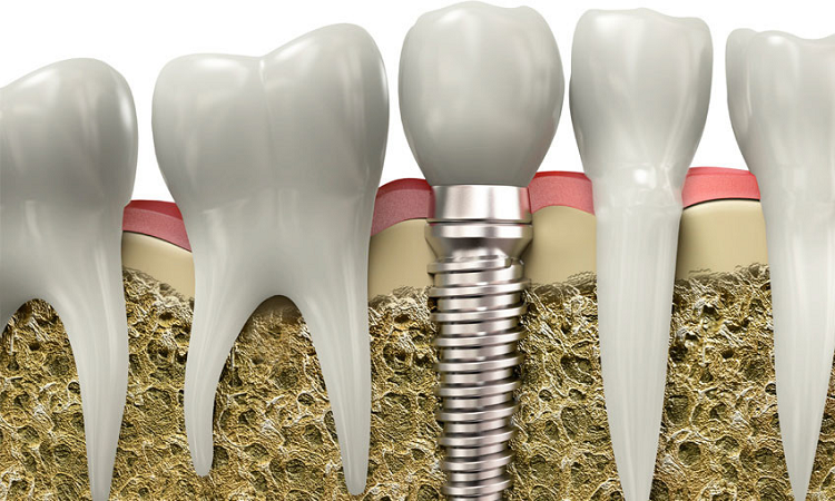 اهمیت ایمپلنت دندان