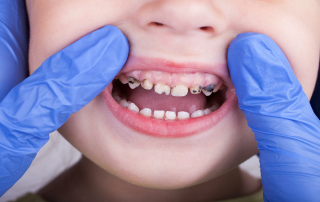 بیماری‌های دندانی در کودکان