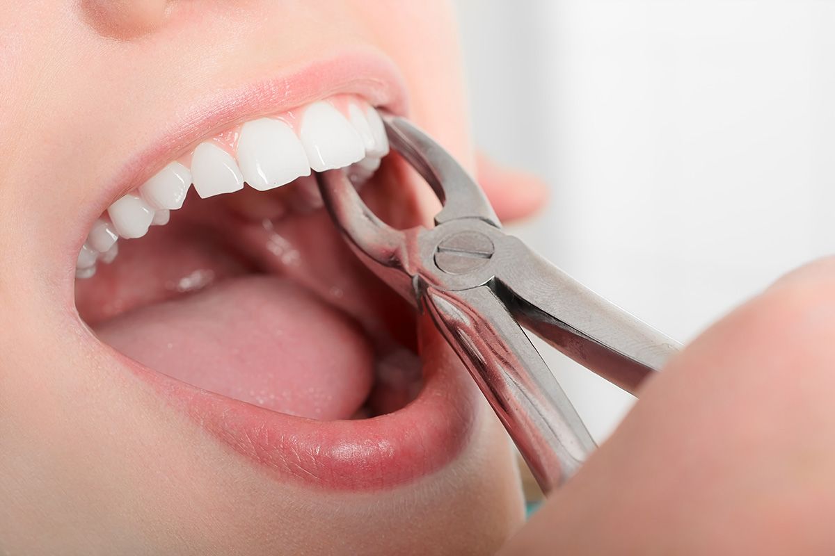 کشیدن دندان 