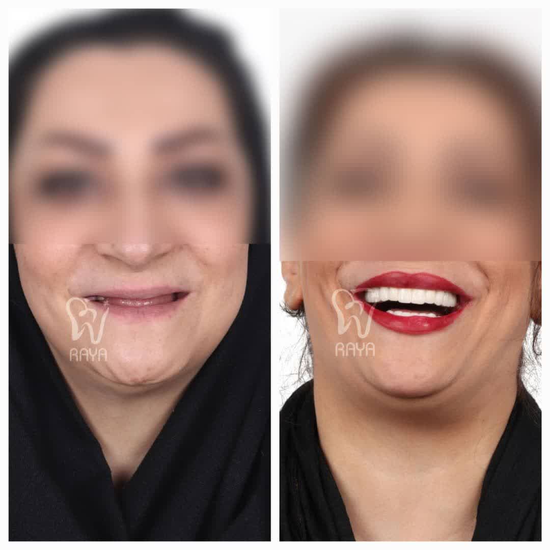 نمونه عکس زیبا شدن دندان ها