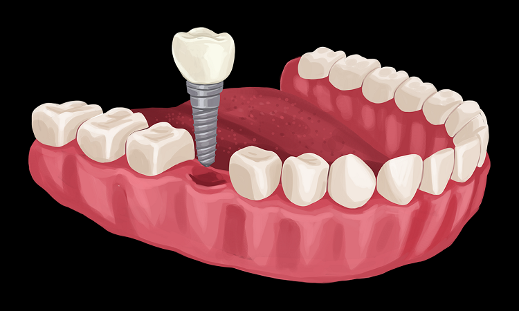 کاشت ایمپلنت دندان