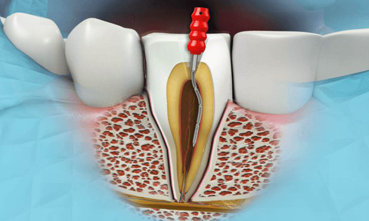 اهمیت میکروسکوپ در دندانپزشکی