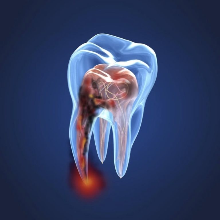 درمان تخصصی ریشه دندان با میکروسکوپ