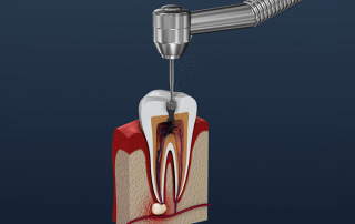 پیشگیری از تخریب دندان در اندوتراپی