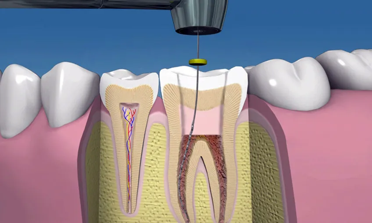 درمان ریشه دندان با اندوتراپی