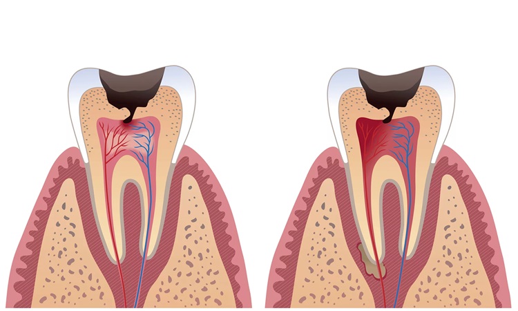 درمان تخصصی ریشه دندان