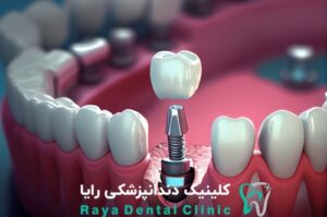 ایمپلنت دندان-کلینیک رایا