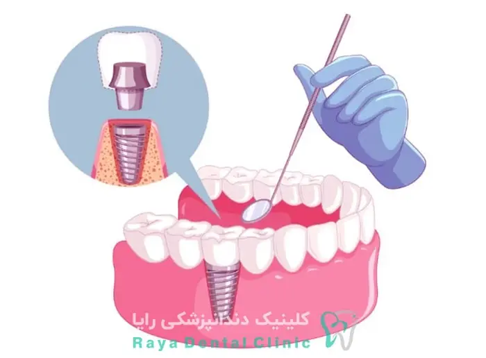 مراقبت های بعد از ایمپلنت دندان-کلینیک رایا