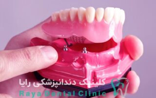دندان مصنوعی یا ایمپلنت دندان