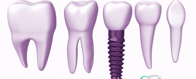 فرایند ایمپلنت دندان