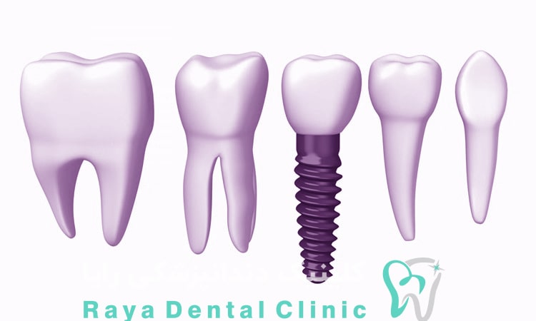 فرایند ایمپلنت دندان