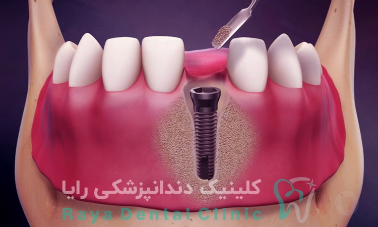 پیوند استخوان دندان چیست؟