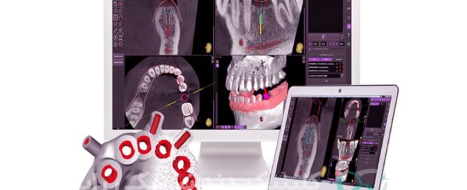 دندانپزشکی ایمپلنت دیجیتال