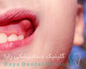 درمان فوری آبسه دندان