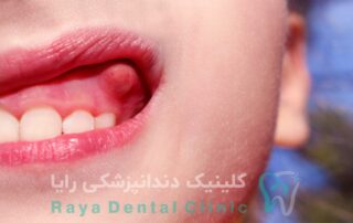 درمان فوری آبسه دندان