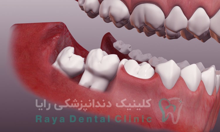 درمان دندان عقل
