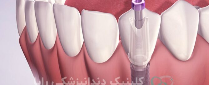  لق شدن ایمپلنت دندان