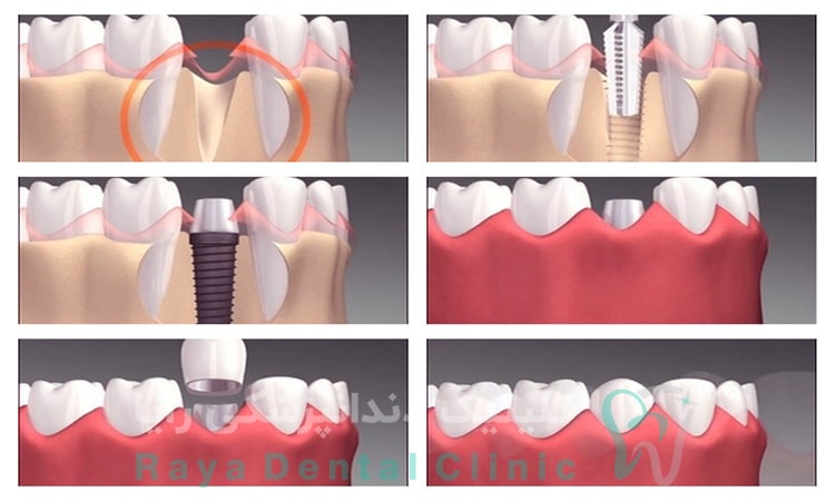  ایمپلنت دندان چیست؟