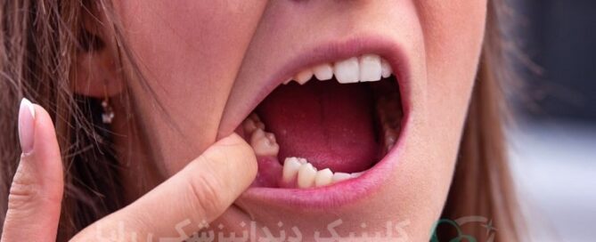 ایمپلنت دندان