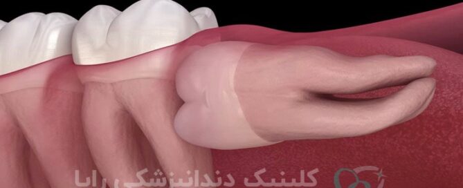 دندان عقل نهفته