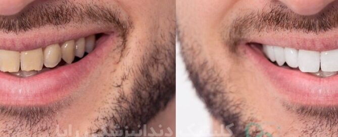 بلیچینگ دندان چیست؟
