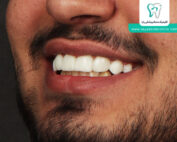 ونیر کامپوزیت دندان
