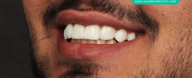 ونیر کامپوزیت دندان