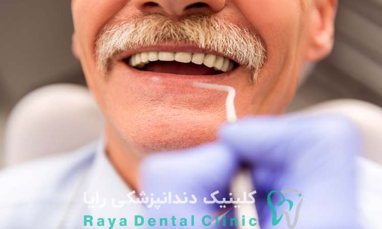 طراحی ایمپلنت اشترومن