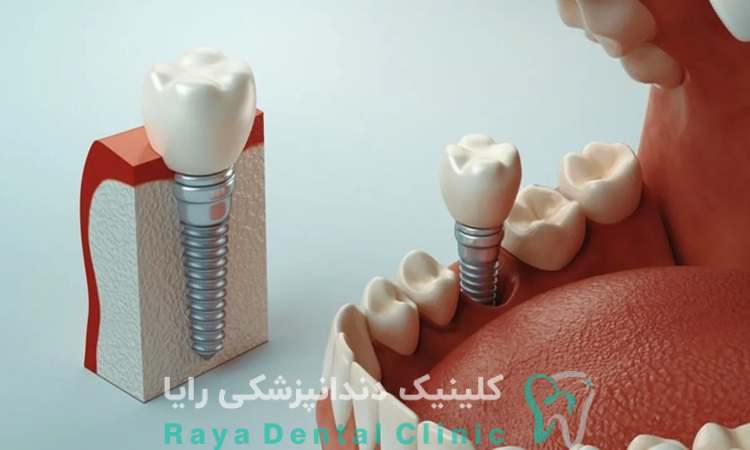 مزایای ایمپلنت اشترومن