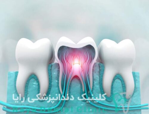 آیا بعد از عصب کشی، دندان ضعیف می‌ شود؟