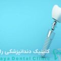 ایمپلنت اروپایی