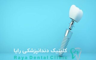 ایمپلنت اروپایی